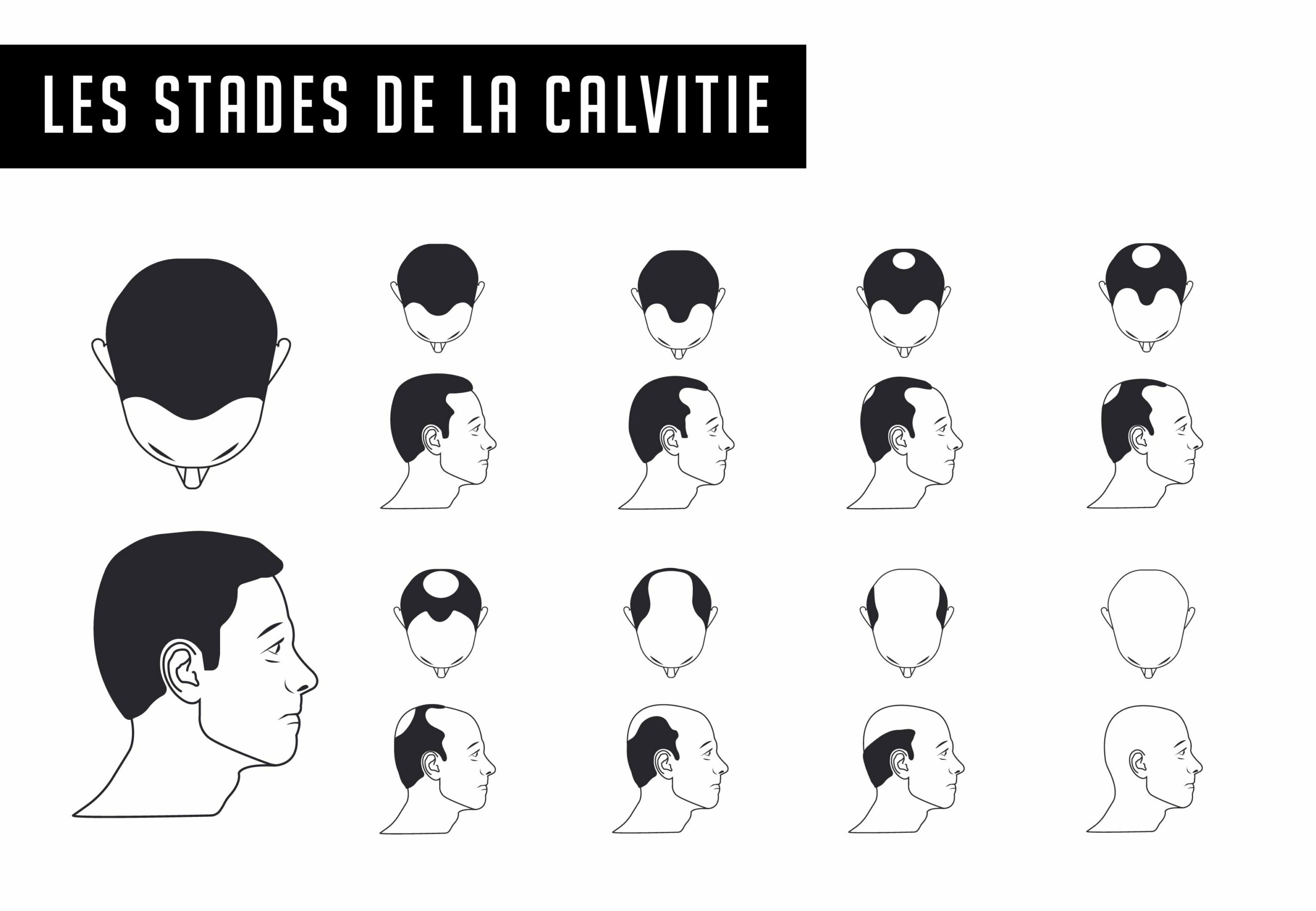 les stades de la calvitie perte de cheveux hommes