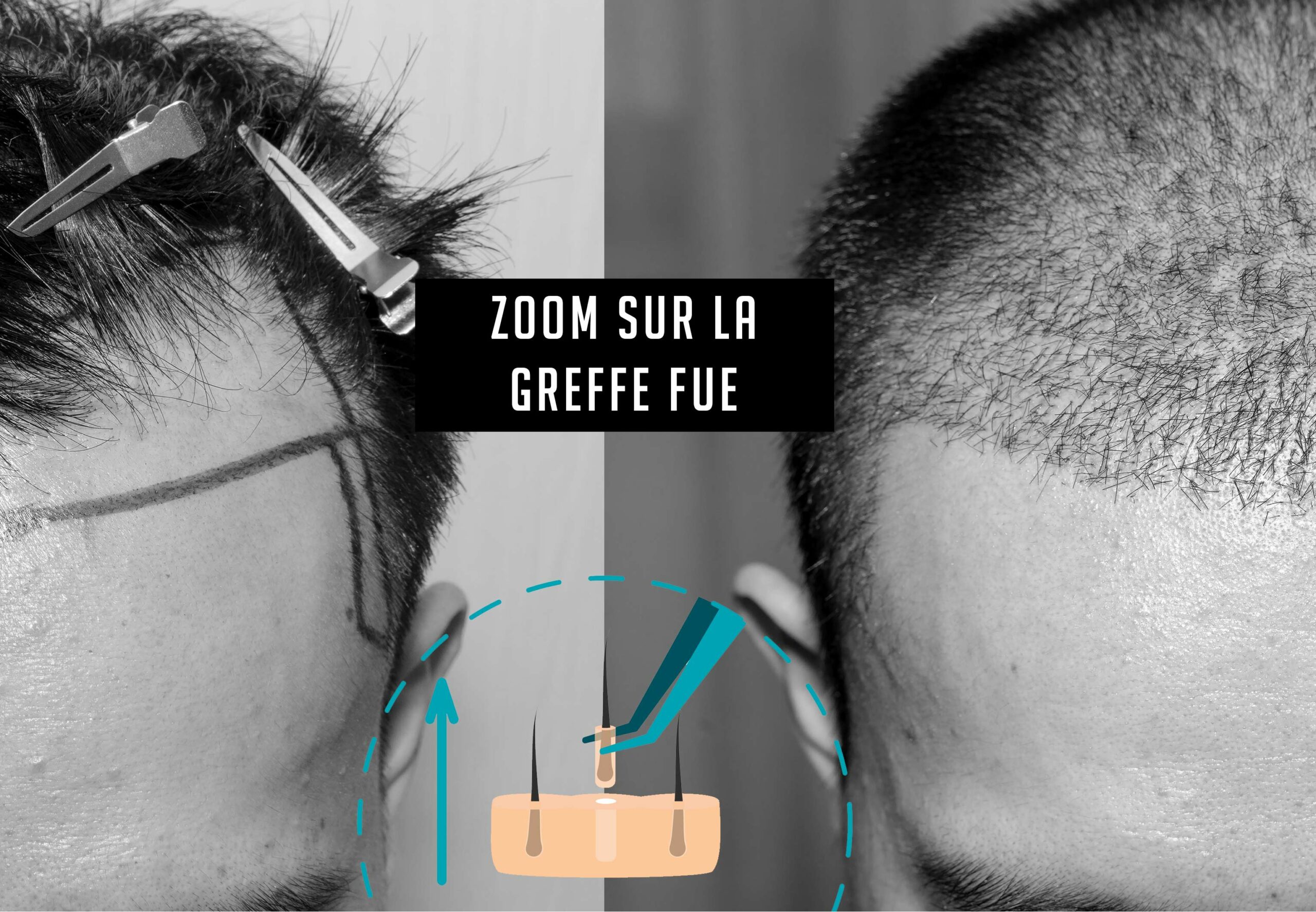 La greffe, une très bonne solution pour cacher sa calvitie, sa perte de cheveux blog greffe fue explicatif katsura scaled