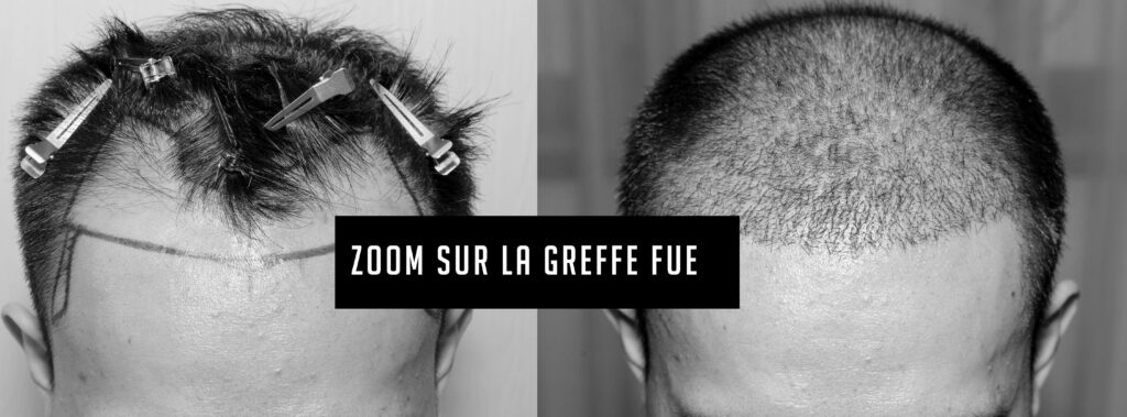 La greffe, une très bonne solution pour cacher sa calvitie, sa perte de cheveux blog greffe fue perte cheveux