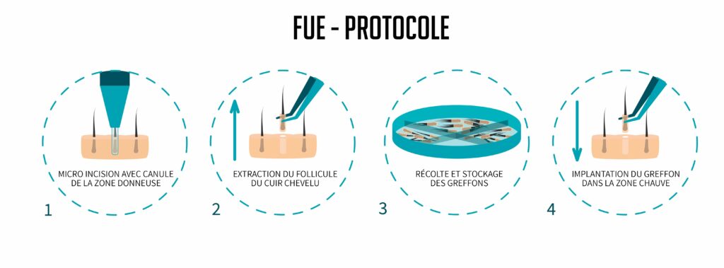 fue greffe transplantation