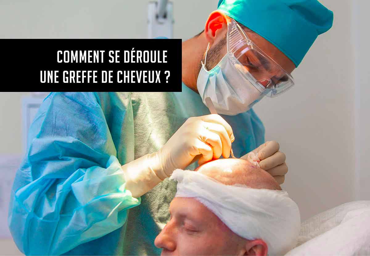 la greffe de cheveux