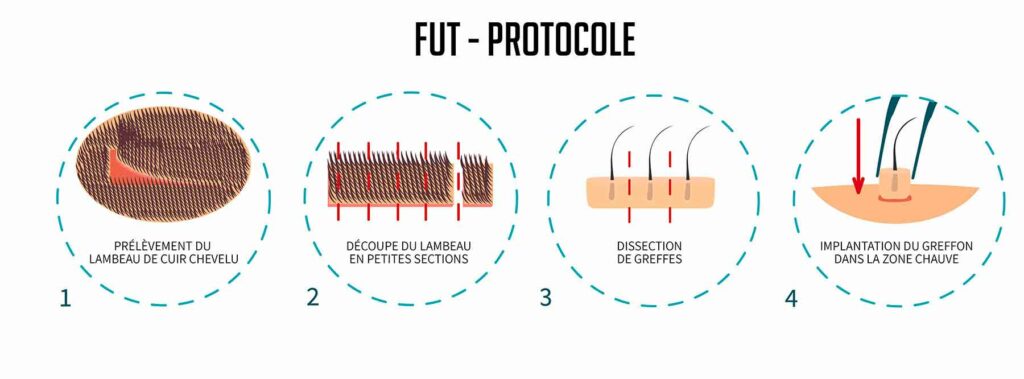 greffe fut transplantation