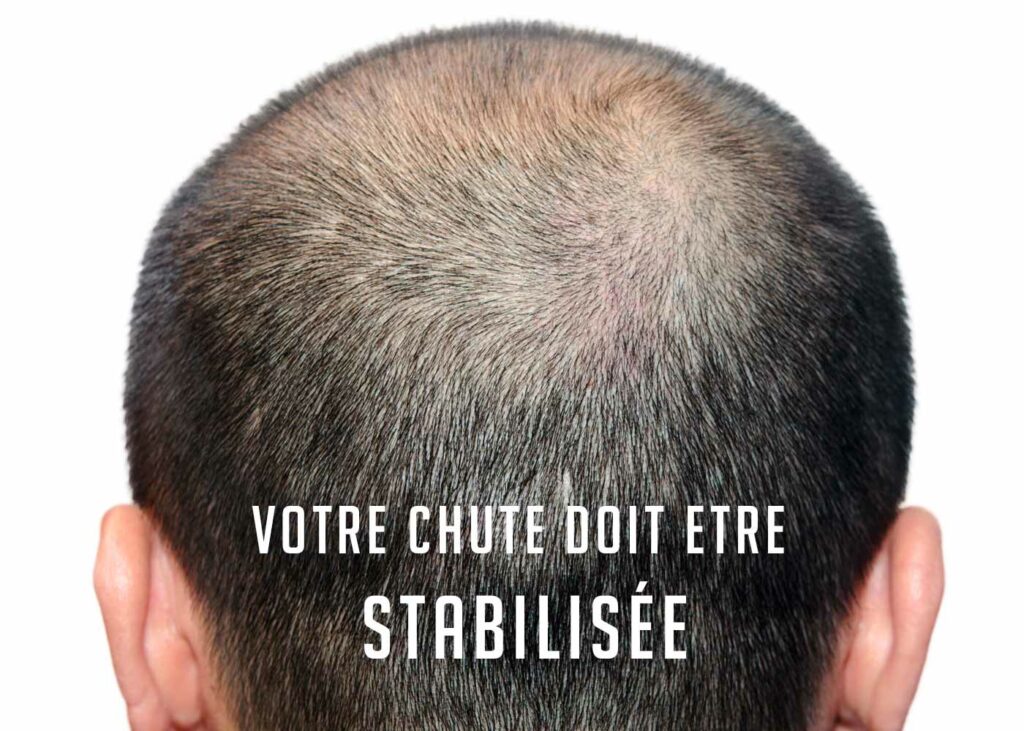 chute de cheveux hommes calvitie