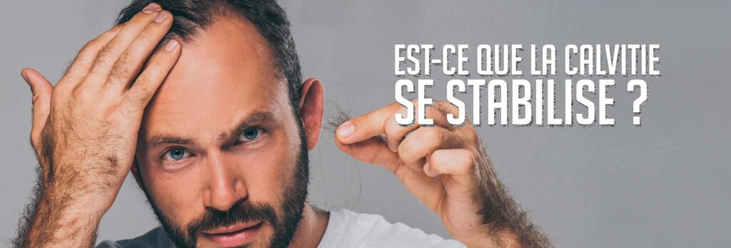 A quel âge la calvitie se stabilise