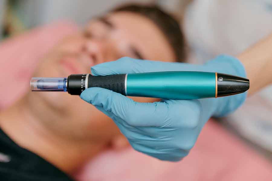 microneedling contre la perte de cheveux