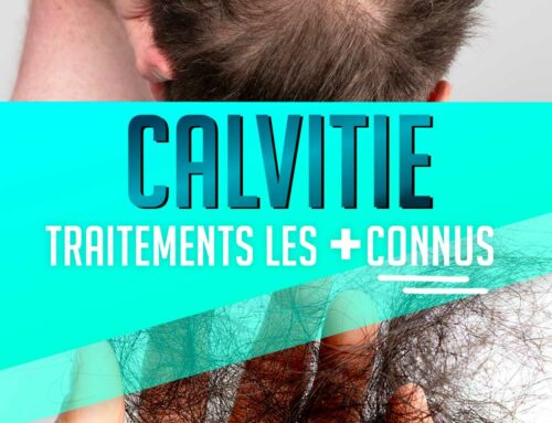 Calvitie traitement: les 2 médicaments plus connus