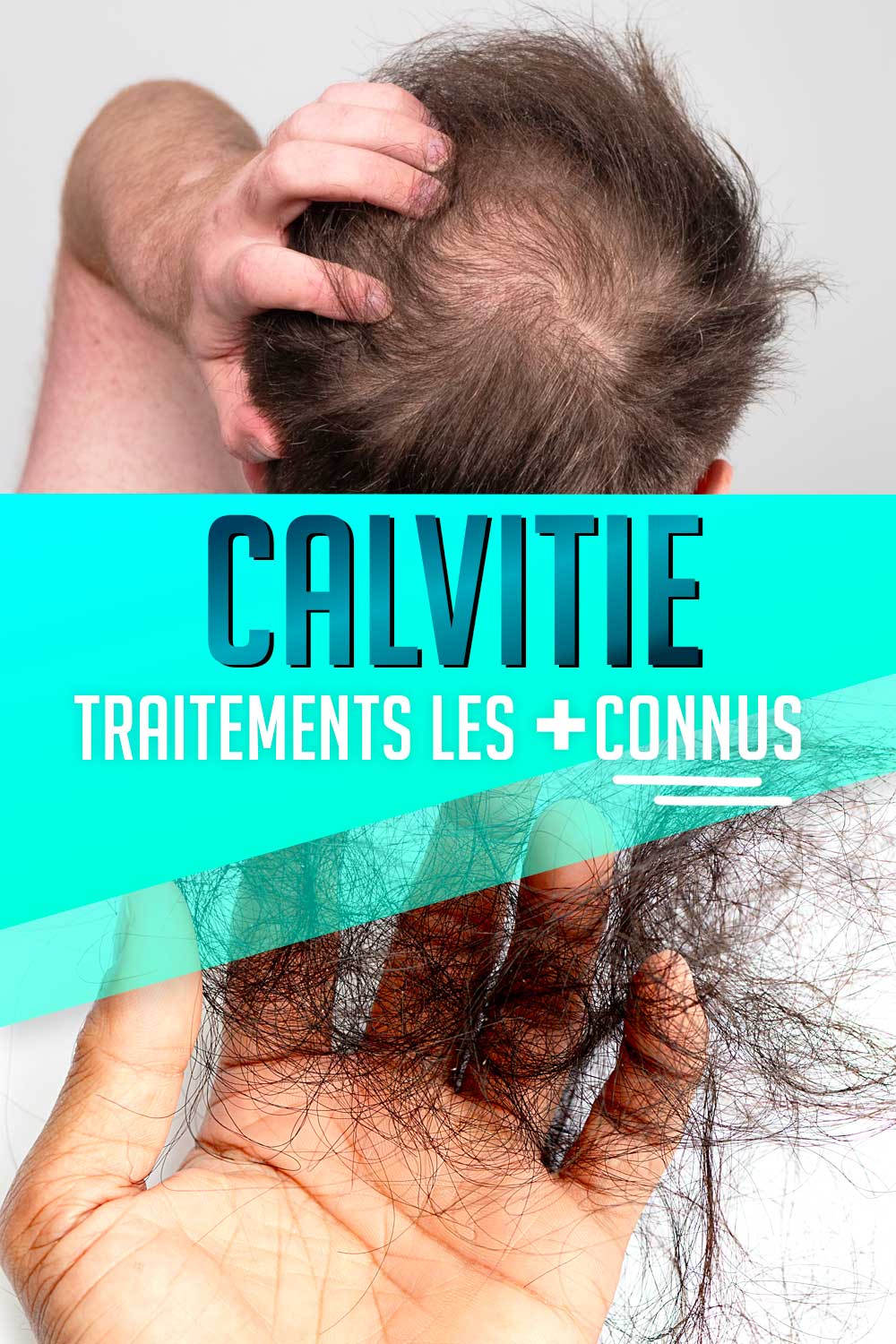 traitements les plus connus de la calvitie sont minoxidil et finasteride