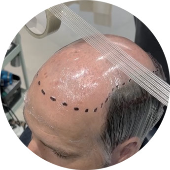 Coiffeur devenez prothésiste ! img empreinte