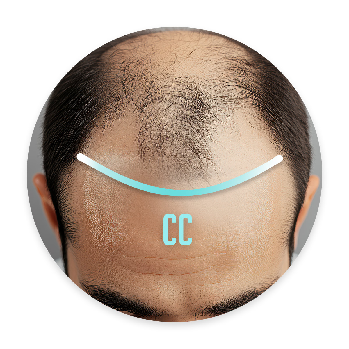 bordure frontale forme CC pour complément capillaire