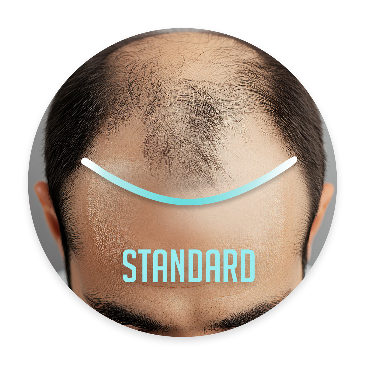 Ma chevelure Sur-mesure bordure STANDARD